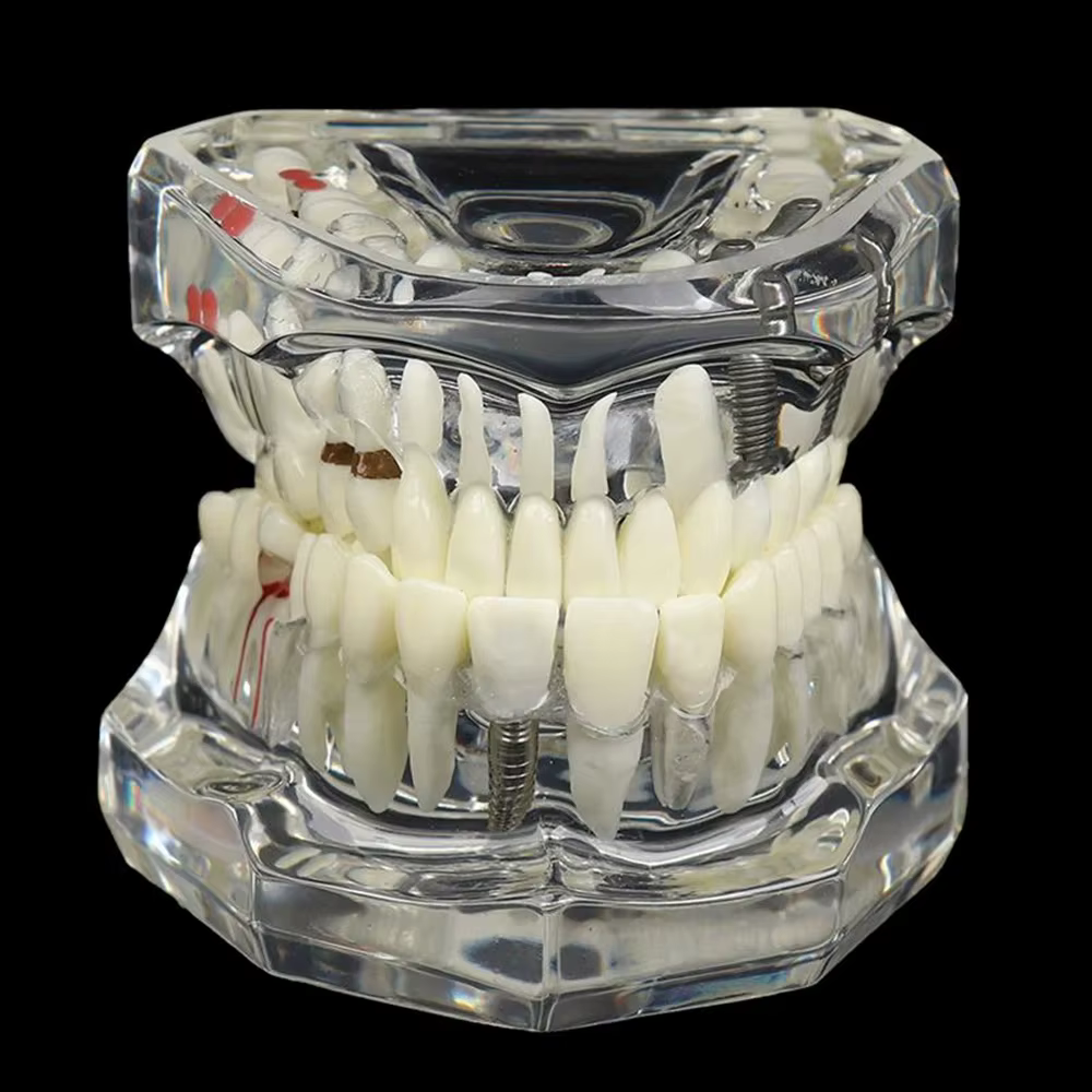 Modèles dentaires amovibles et restaurables de dents malades pour l'enseignement et la recherche sur