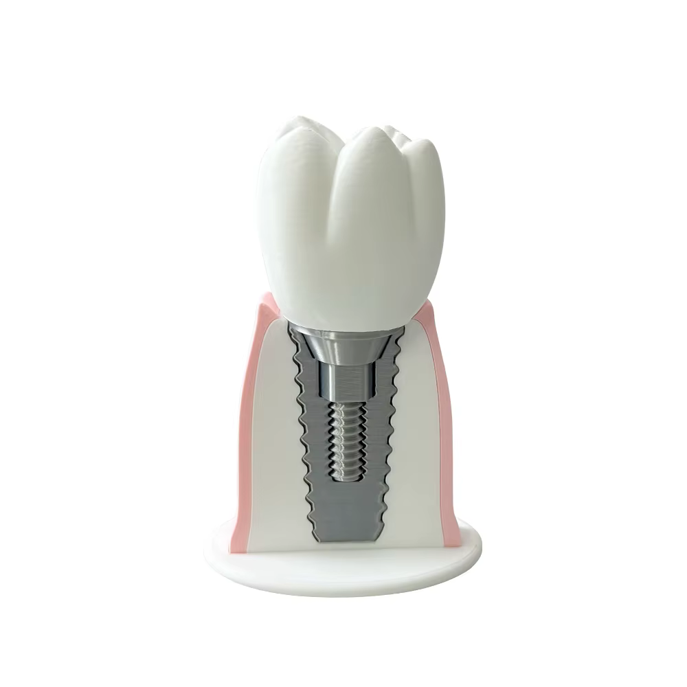 Modèle de dent implantable avec couronne et vis amovibles, outil de démonstration éducatif pour clin